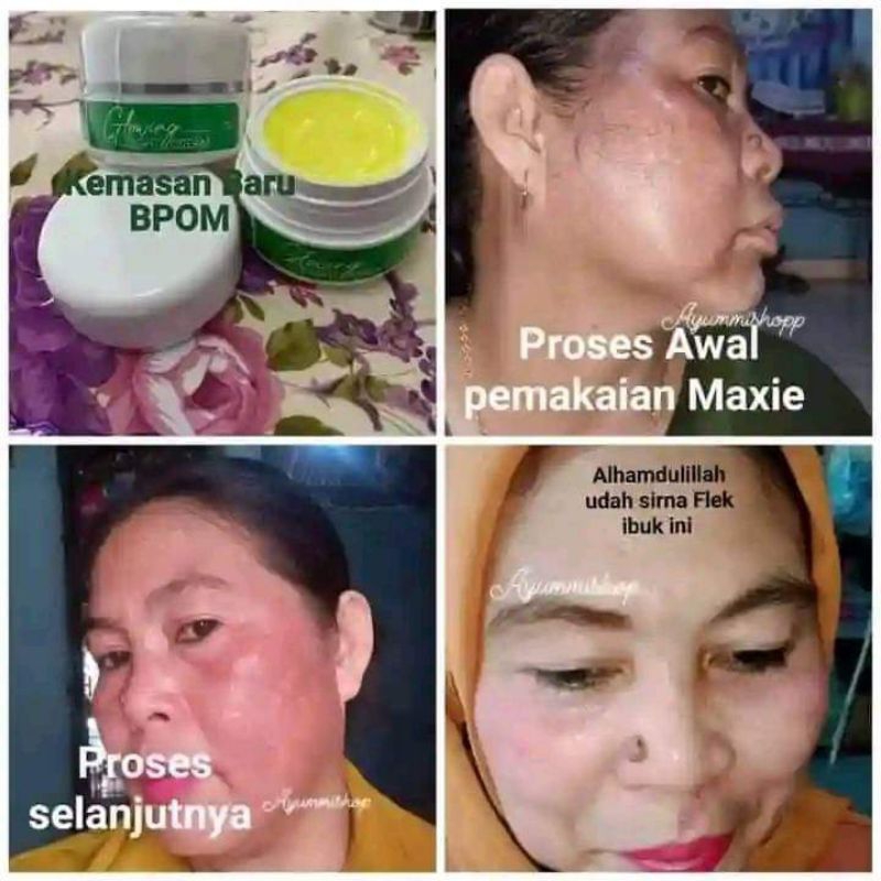 PAKET FLEK MAXIE GLOW