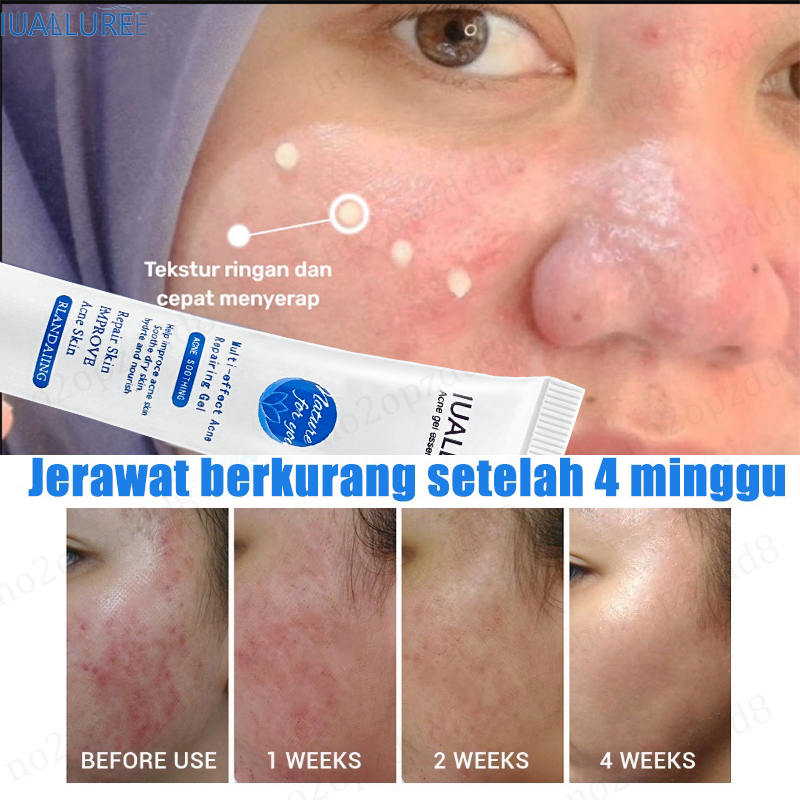 [COD] IUALLURE PENGHILANG JERAWAT 20G JERAWAT PARAH MERADANG BOPENG KRIM ACNE GLOW WHITE SALICYLIC A