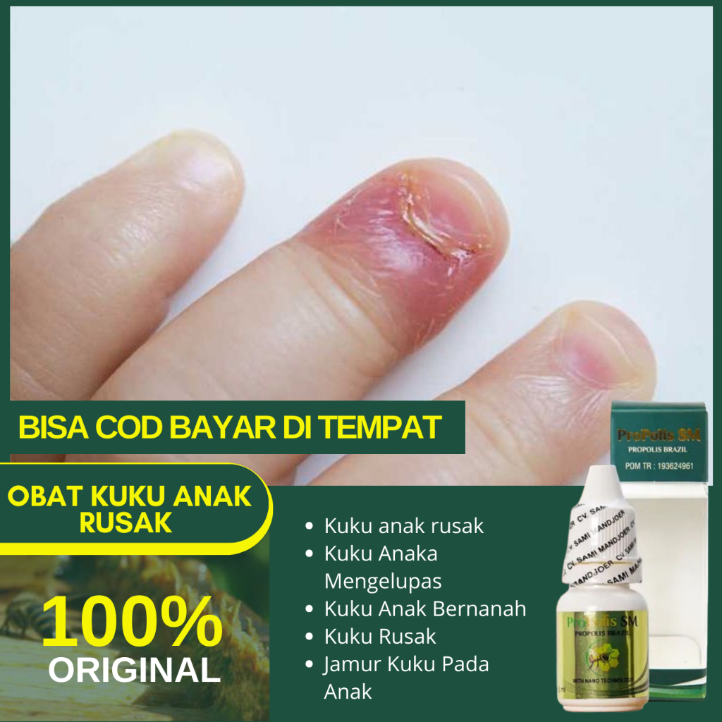 Obat Kuku Mengelupas Pada Anak, Kuku Anak Bernanah, Rusak, Jamur Kuku Pada Anak