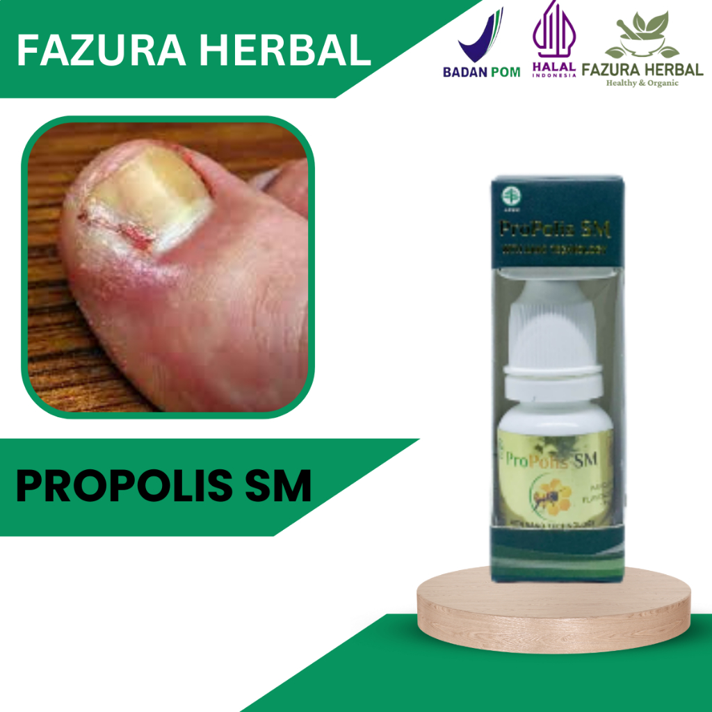 Propolis SM - Obat Cantengan Jempol Kaki, Obat Cantengan, Obat Cantengan Kaki, Obat Cantengan Kuku, 