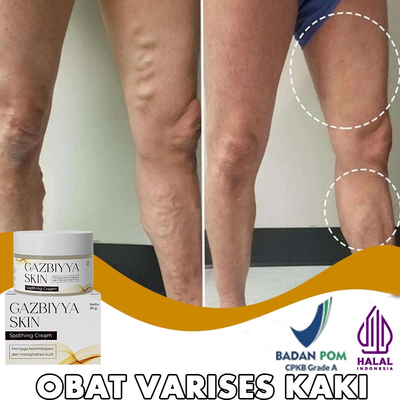 KODE J86O Obat varises kaki valesin obat varises original salep varises obat varikokel 3g salep laba