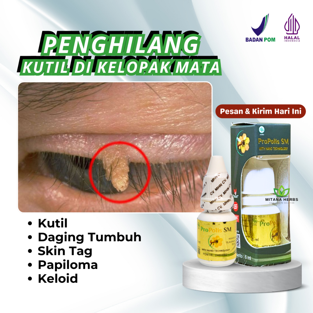 Obat Kutil di Kelopak Mata, Obat Kutil Daging Tumbuh, Kutil di Leher Papiloma Daging Jadi Skin Tag