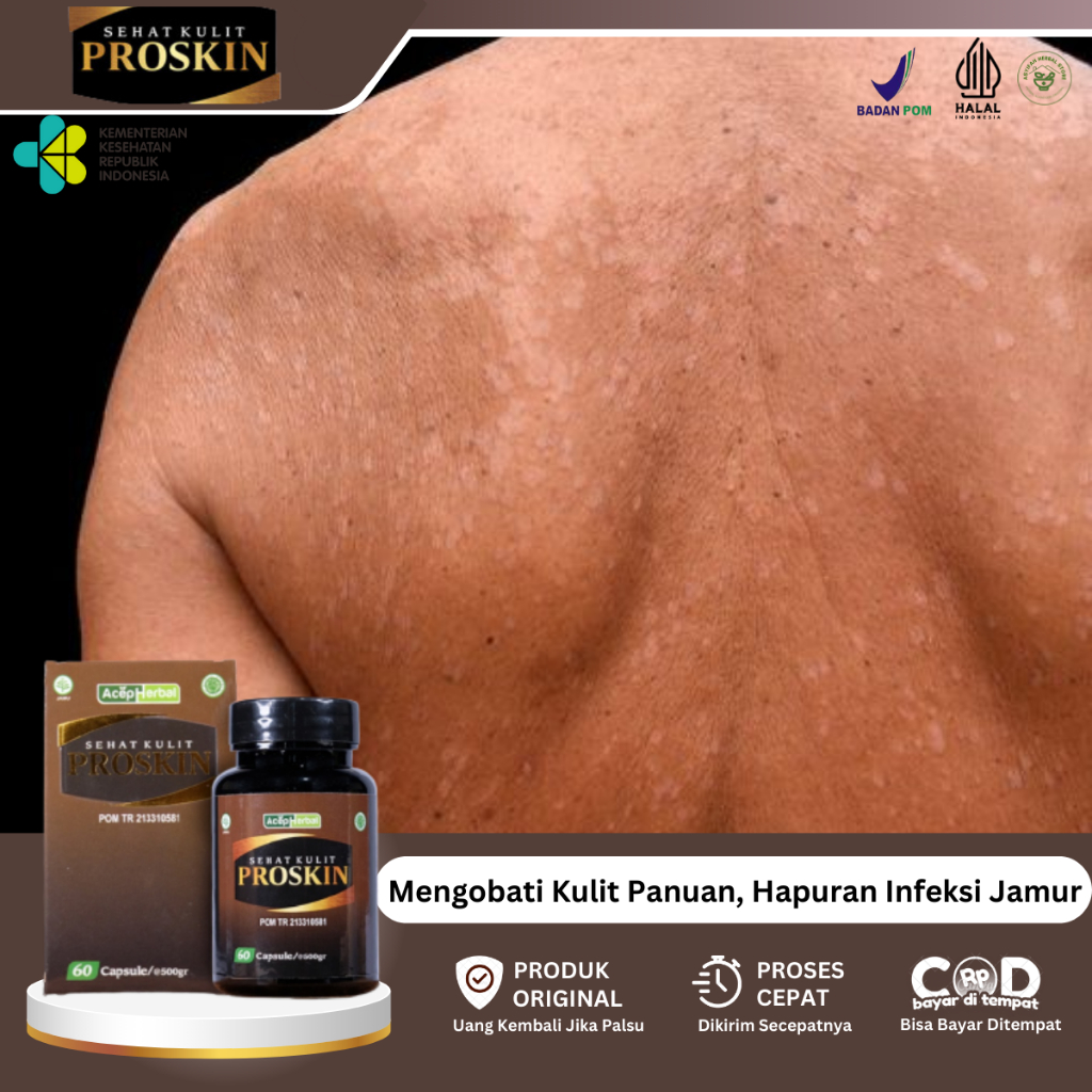 Obat Panu, Obat Panu Seluruh Badan, Obat Bercak Putih Di Kulit, Obat Kulit Berjamur, Obat Jamur Kuli