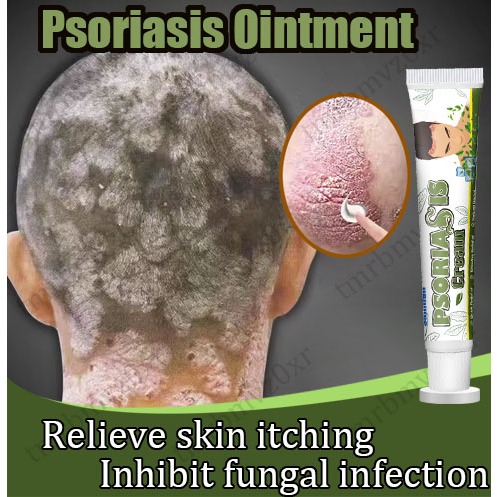 Krim psoriasis Obat Psoriasis Kulit jamur Kulit Kepala Gatal Berkerak 20gr Salep Eksim paling ampuh 