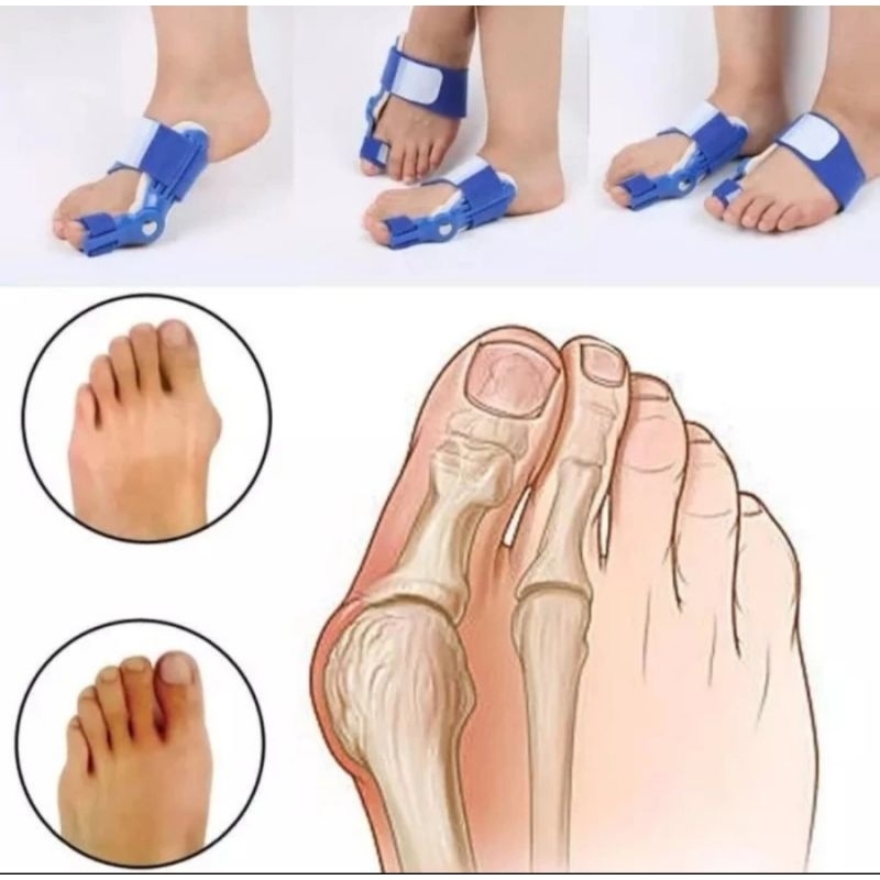 Alat Correction Bunion Hallux Valgus Splint All Size untuk Kaki bunion