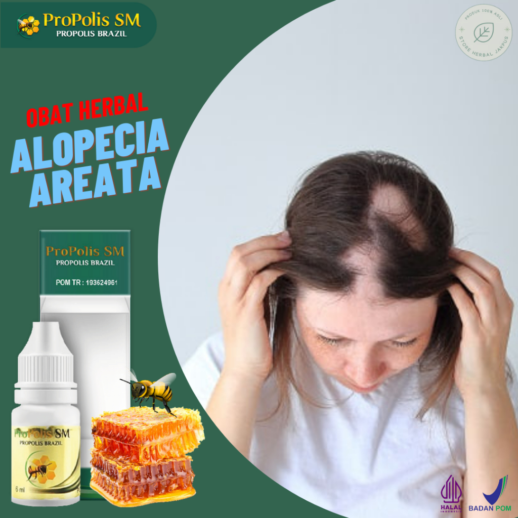 Obat Alopecia Areata Penghilang Botak Koin Pitak Penumbuh Rambut Botak Tinea Capitis