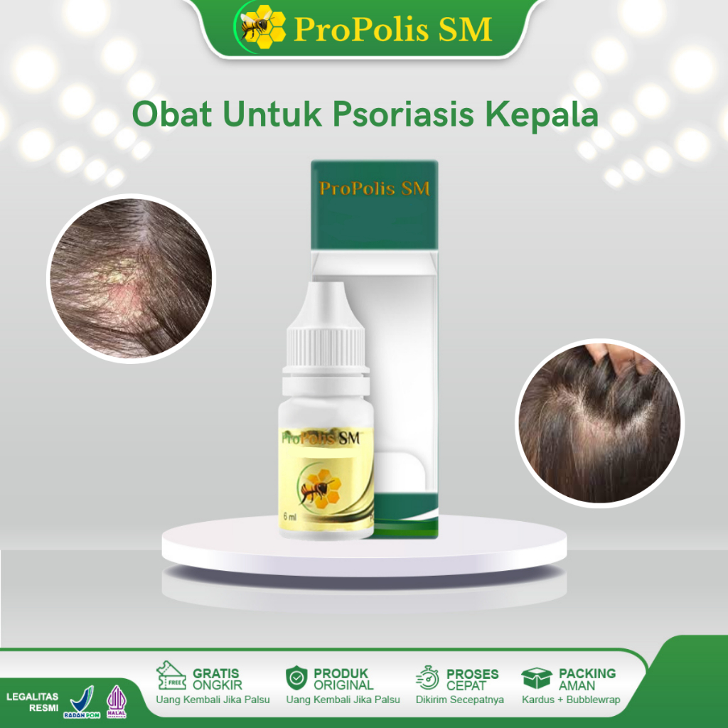 Obat Psoriasis Kulit Kepala Ketombe Berkerak Ketombe Parah Gatal Kulit Kepala Dermatitis Seboroik In