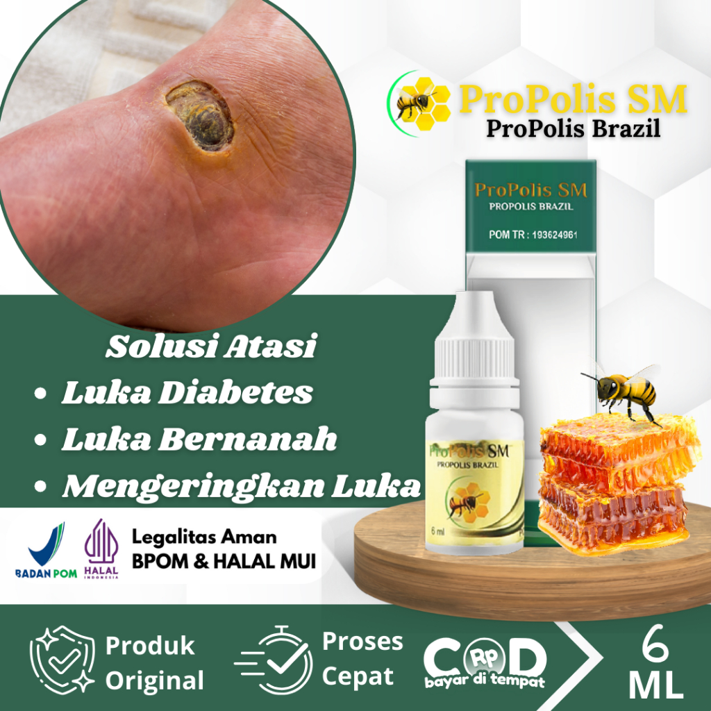 Obat Luka Diabetes, Obat Luka Diabetes Basah Agar Cepat Kering, Obat Luka Diabetes Bernanah, Obat Pe