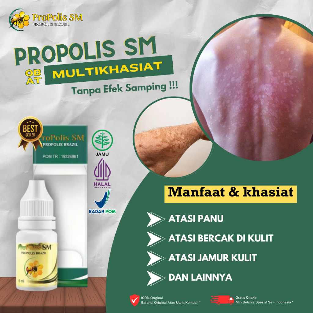 Obat Penghilang Panu, Obat Penghilang Balas Bogo, Obat Bercak Putik Di Wajah, Obat Penghilang Hapur,