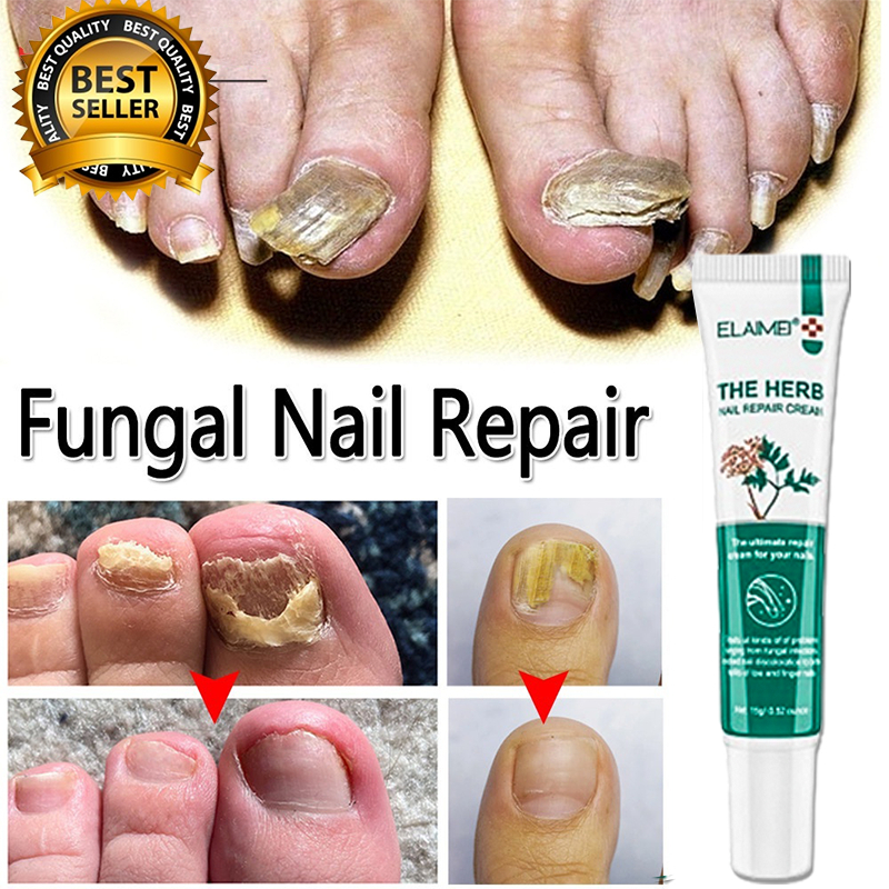 obat kuku jamur dan rusak salep kuku jamur dan rusak obat kuku rusak jamur kuku obat paling ampuh ku