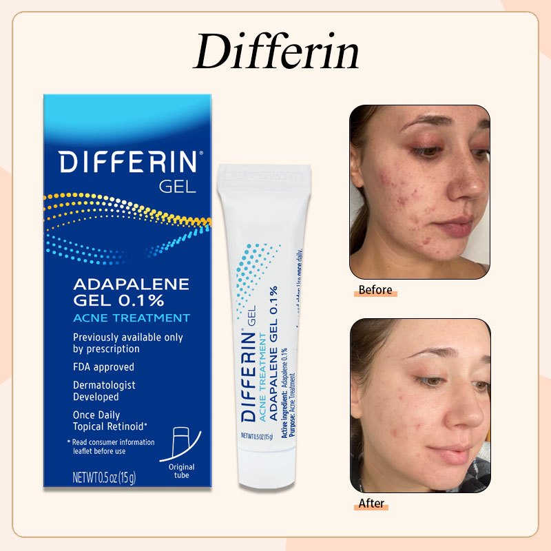 Differin Acne Treatment Gel 15 gram / Acne Treatment / Adapalene Adapalen Gel 0.1%