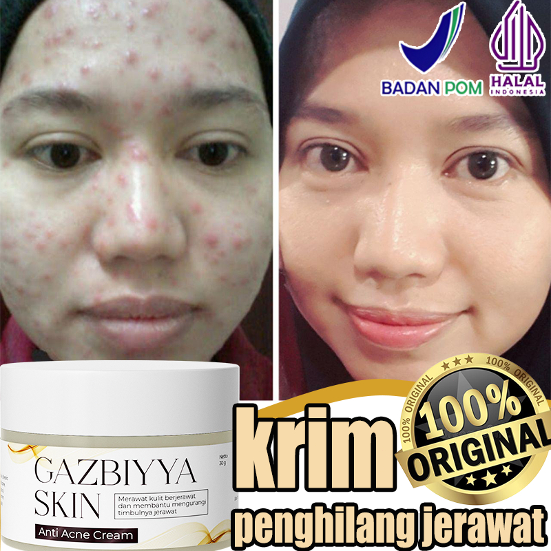 penghilang bekas jerawat dan bopeng penghilang hitam bekas jerawat penghilang lubang bekas jerawat 3