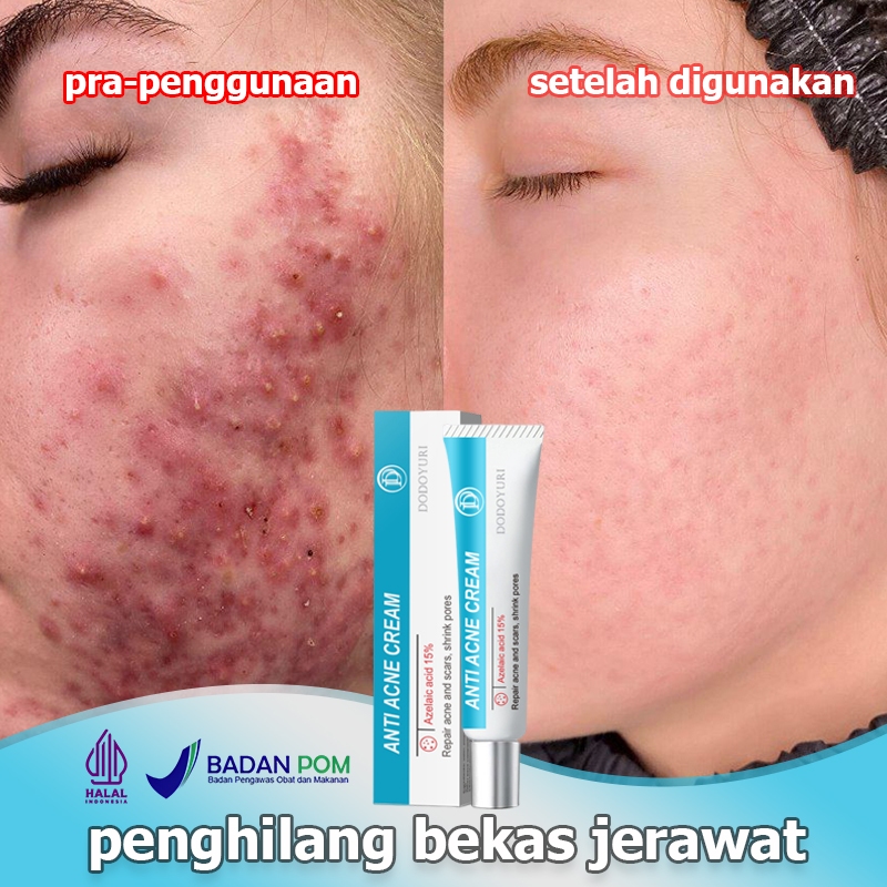 Salep jerawat Menghilangkan bekas jerawat Obat totol jerawat Penghilang bekas jerawat Obat jerawat 2