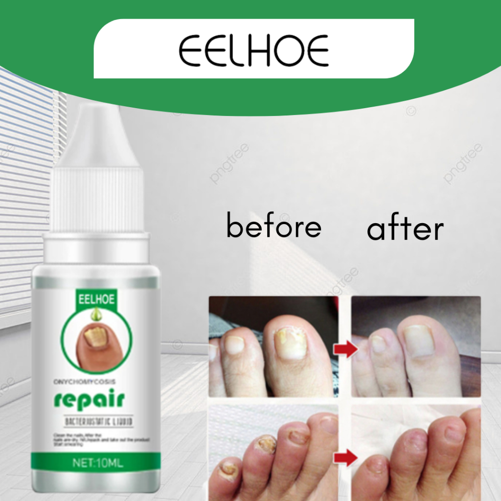 obat jamur kuku menguning dan rusak obat perbaikan kuku jempol kaki yang bau dan cantengan