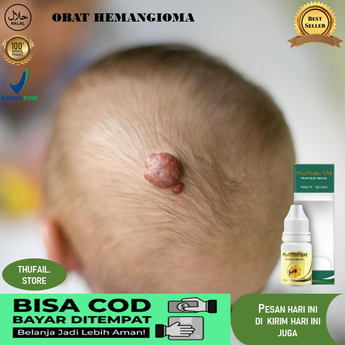 obat hemangioma Obat Herbal Hemangioma Tumor Obat Hemangioma, Tumor Hemangioma, Benjolan Kemerahan P