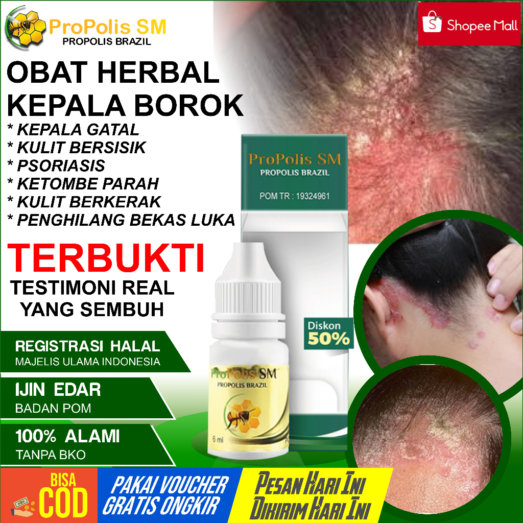 Obat Koreng Di Kepala Borok di Kulit Kepala Psoriasis Kulit Bersisik Kering Luka Borok Koreng Di Kep