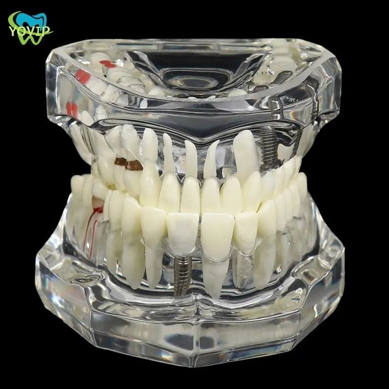 Model Gigi Studi Implan / Dental teeth Implan Restoration