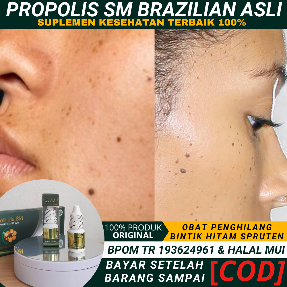 Propolis SM Untuk Menghilangkan Spruten di Wajah dan Leher, Bintik Hitam di Wajah Seperti Tahi Lalat