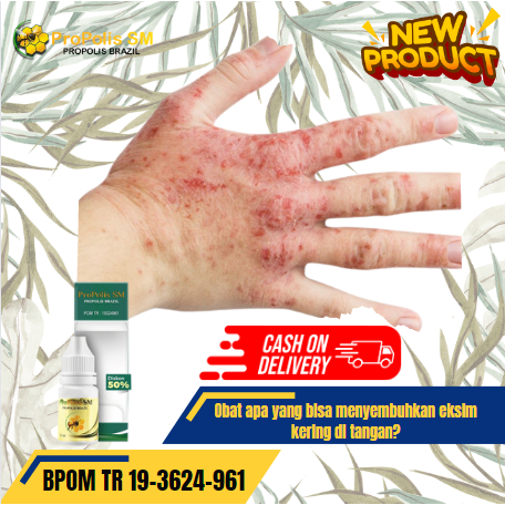 Obat apa yang bisa menyembuhkan eksim kering di tangan? Obat Penghilang Dermatitis atopik, Xeroderma