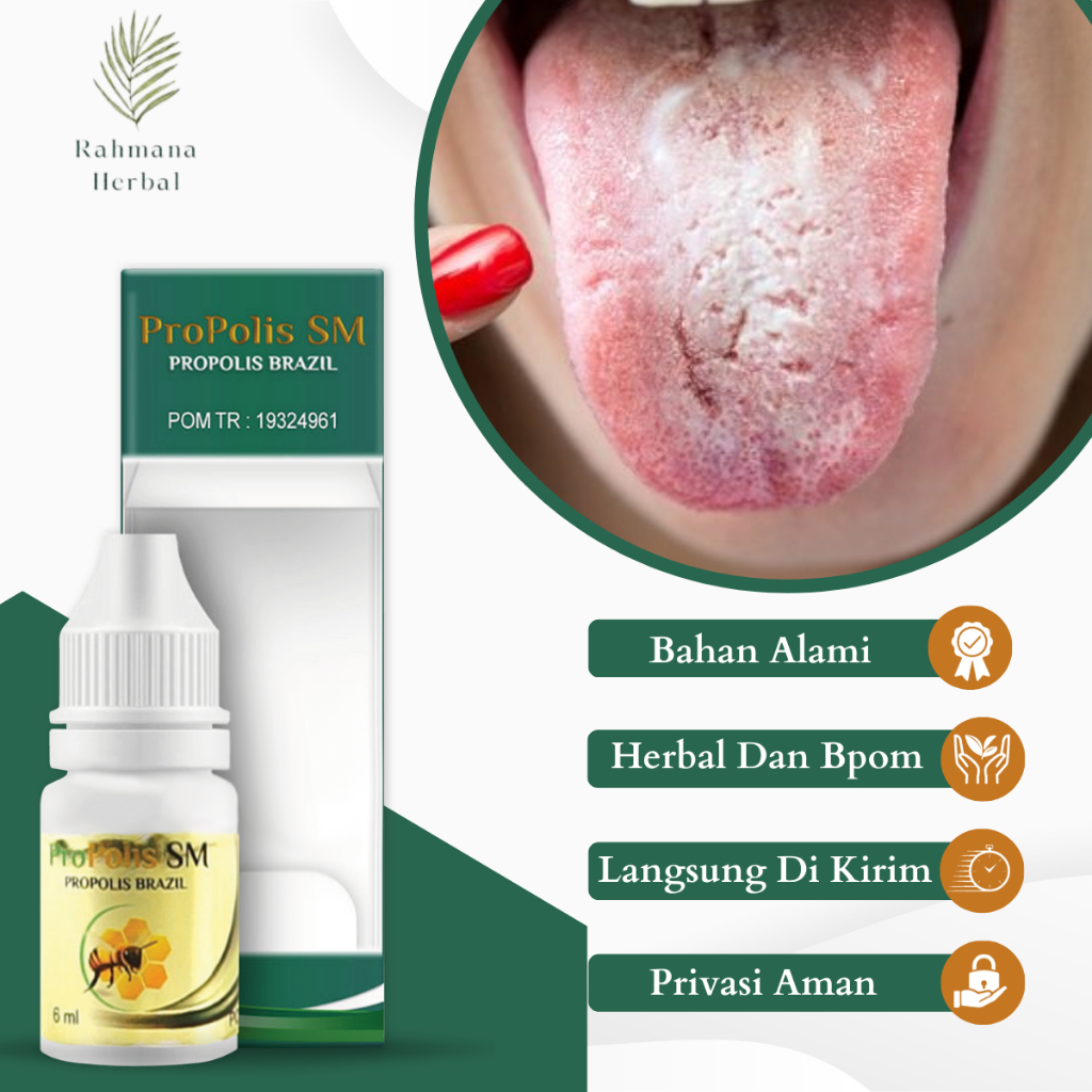 Obat Tetes Lidah Berjamur, Obat Lidah Putih Berjamur, Obat Infeksi Jamur Pada Lidah, Obat Kandidasi,