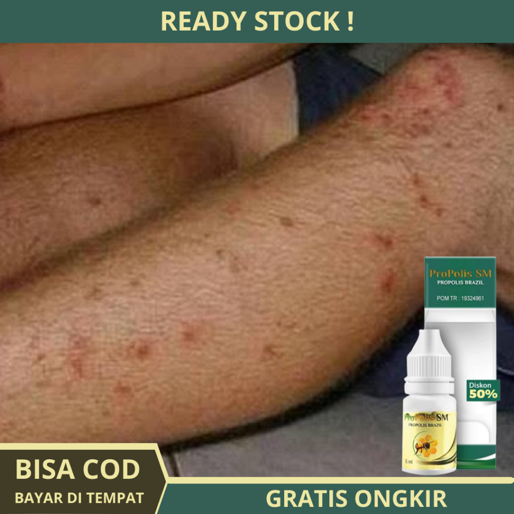 Obat Koreng di Kaki, Obat Menghilangkan Bekas Koreng di Kaki Yang Sudah Lama, Obat Penghilang Bekas 