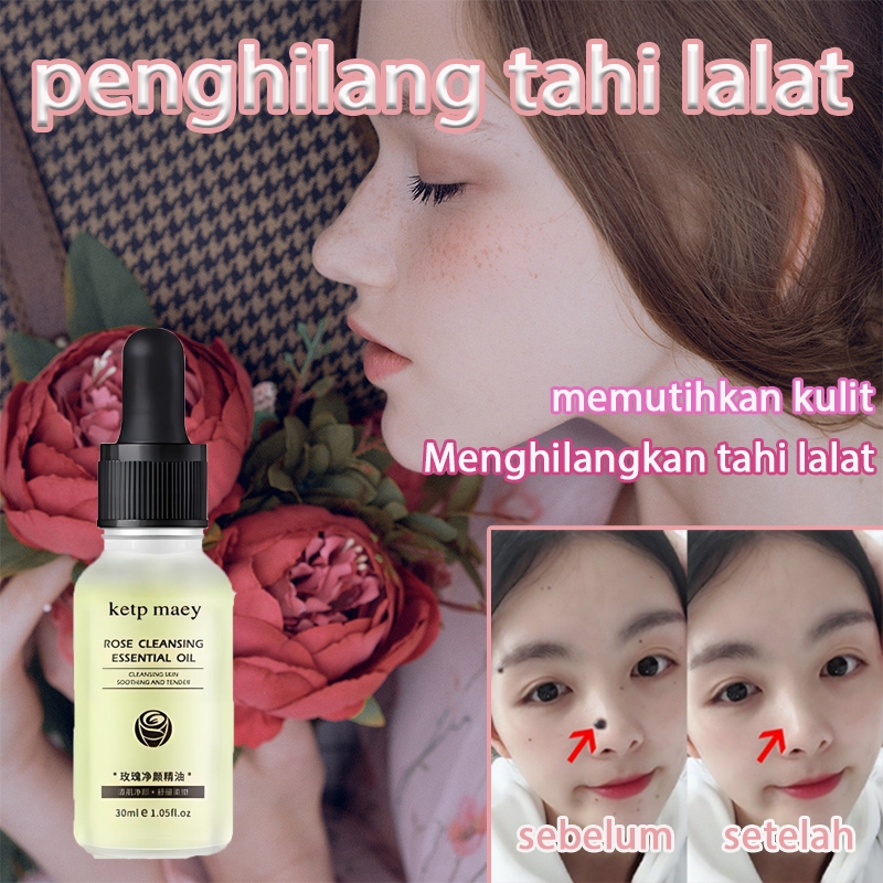 Penghilang tahi lalat obat penghilang tahi lalat penghilang tahi lalat di wajah penghilang tahi lala