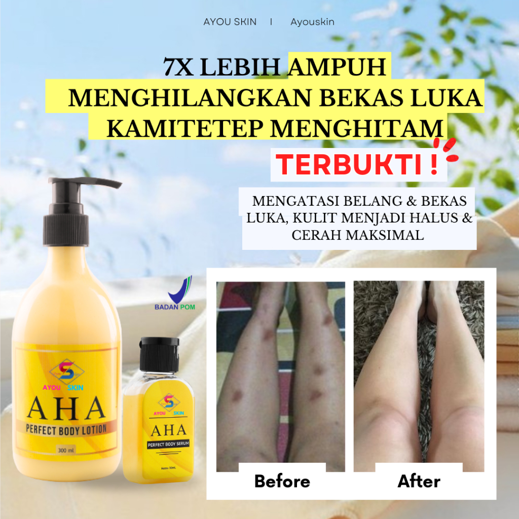 Body Lotion Menghilangkan Bekas Luka Korengan Kamitetep, Menghilangkan Bekas Luka Korengan Di Tangan