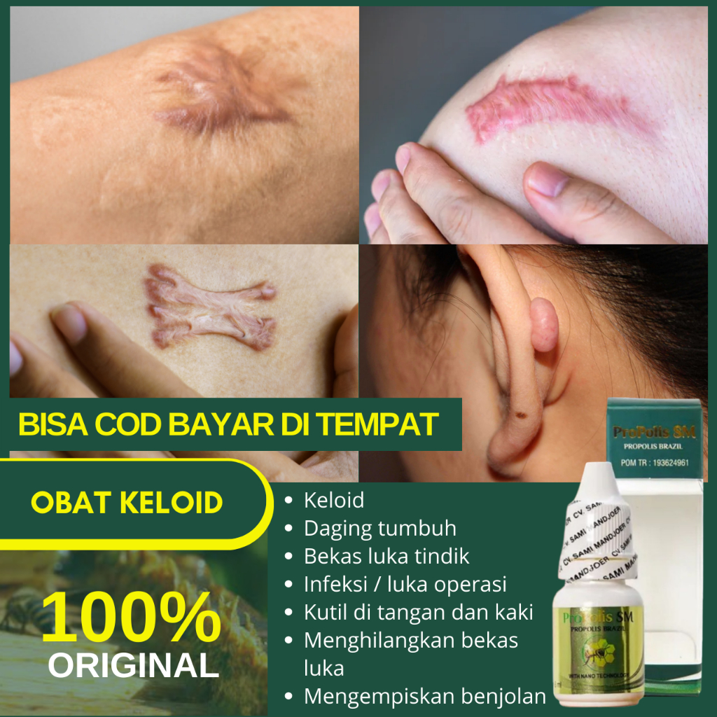 Obat Penghilang Keloid, Penghilang Bekas Luka, Streachmark / Streach mark, Bekas Jerawat, Salep Peng