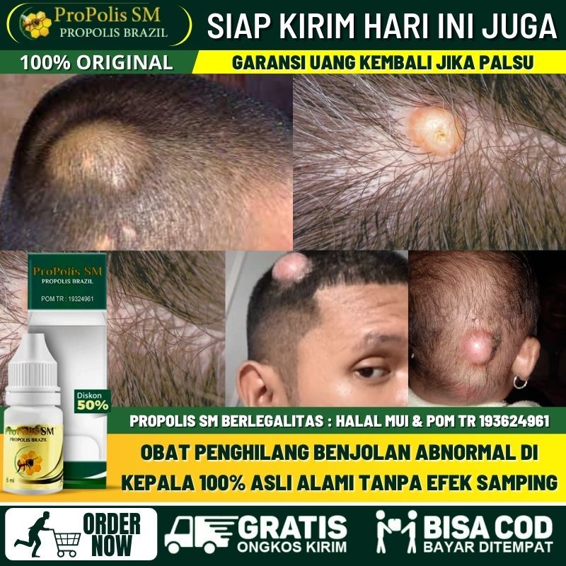 Obat Penghilang Benjolan Dari Lahir di Kepala, Obat Oles Benjolan Aneh di Atas Kepala, Benjolan di R