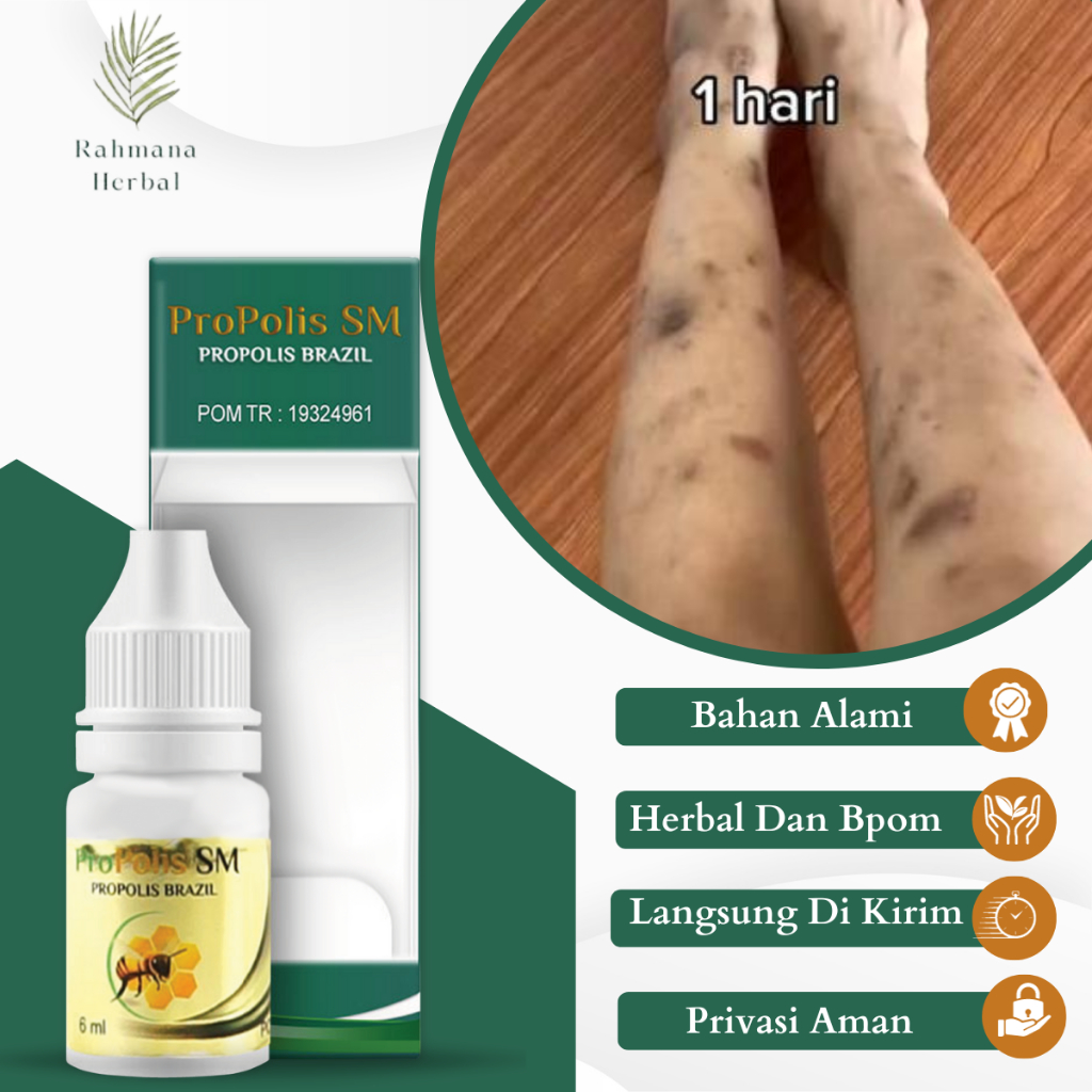 Obat Gatal Korengan, Obat Korengan Bernanah, Obat Kulit Korengan, Obat Korengan Menahun, Obat Luka K