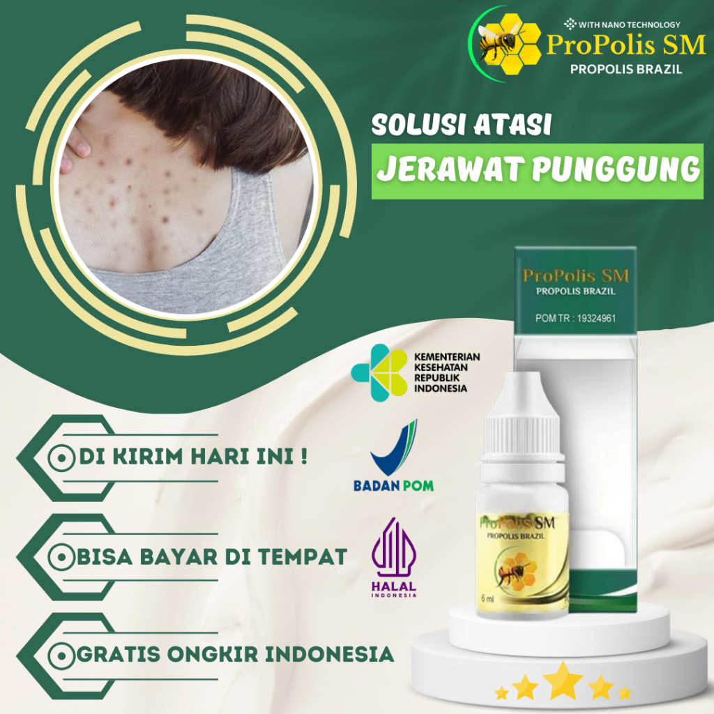 Obat Jerawat punggung, Salep Jerawat punggung, Obat jerawat badan, Obat Jerawat punggung PROPOLIS SM