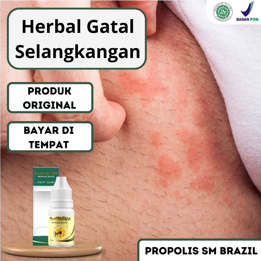 Obat Gatal Jamur Selangkangan , Salep Gatal Cair Selangkangan , Infeksi Jamur , Skabies Dan Hitam Se