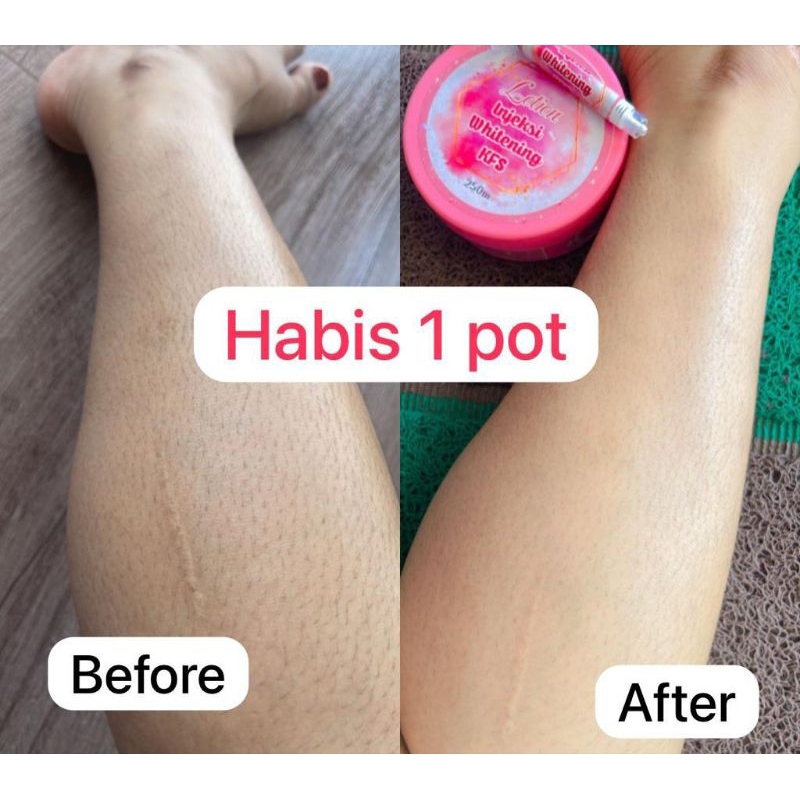 lotion injeksi whitening