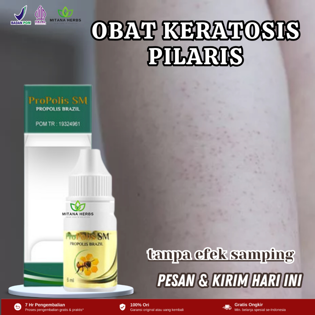 Obat Keratosis Pilaris, Obat Penyakit Kulit Ayam, Obat Bintik Hitam Di Kulit, Obat Kulit Gatal Dan K