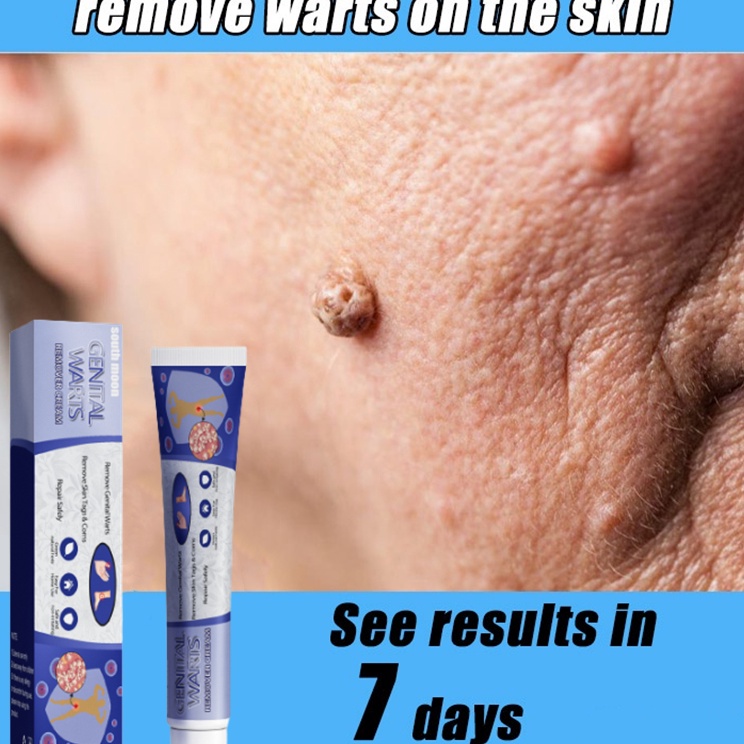 Penghilang skin tag Krim kutil Obat kutil kelamin Penghilang tahi lalat Krim penghilang kutil Menghi