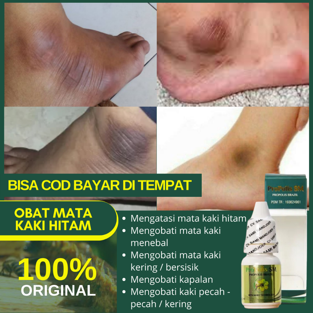 Obat Mata Kaki Hitam Dan Kering, Pemutih Mata Kaki Hitam Kapalan Dan Tebal Dengan Propolis SM