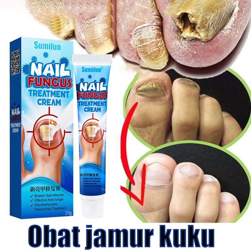 Obat kuku jamur dan rusak Obat jamur kuku Vitamin kuku rusak Obat jamur kuku kaki Salep jamur kuku P
