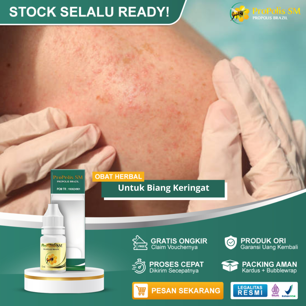 Obat Biang Keringat Gatal-Gatal Biang Keringat Ruam Merah Bintik Merah Kulit Biang Keringat Biang Ke