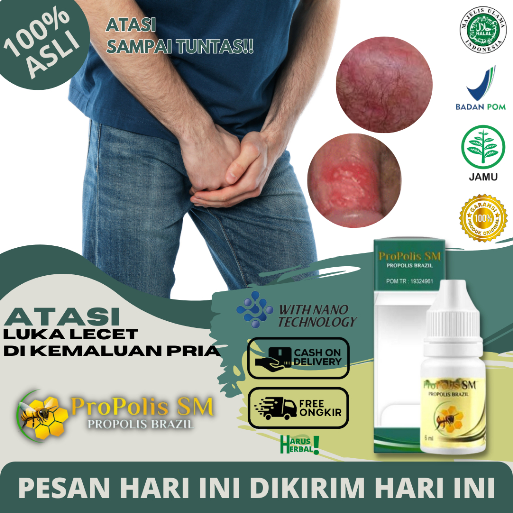 Obat Gatal Kemaluan Kelamin Pria Lecet Herpes Bentol Gatal di Alat Kelamin Pria - Propolis SM