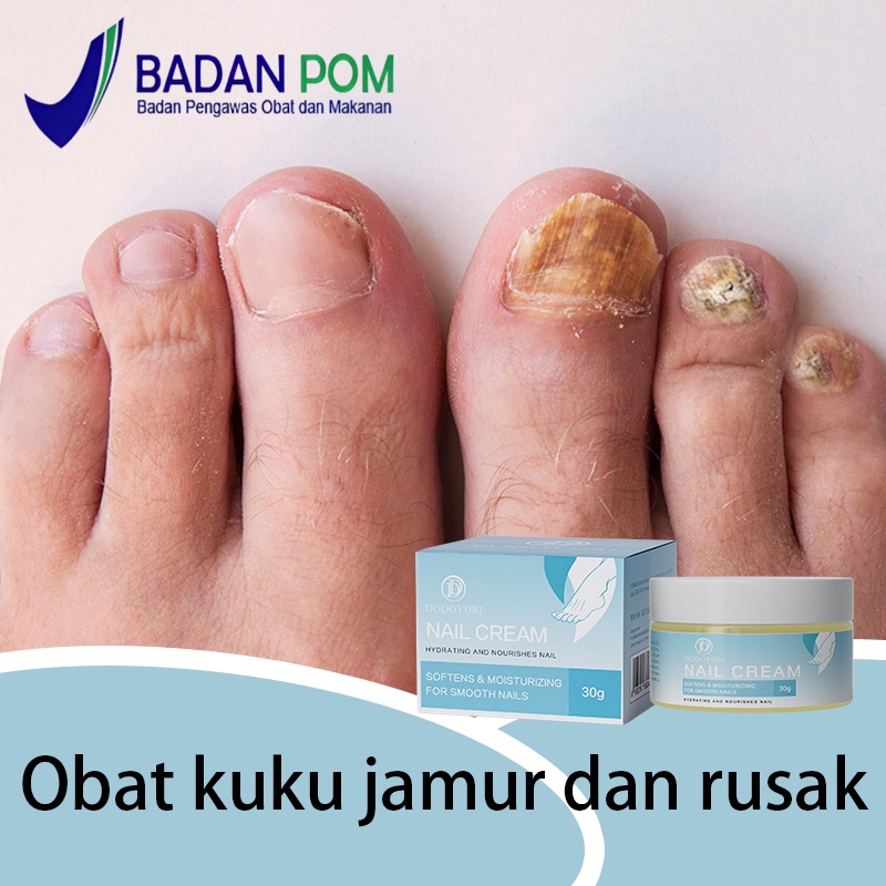 [BPOM] Obat jamur kuku Obat kuku jamur dan rusak vitamin kuku rusak 30g Obat kuku cantengan jempol k