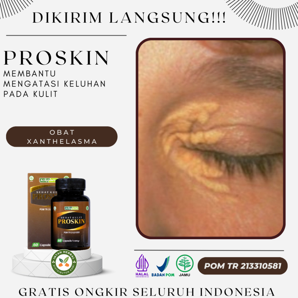 Obat Xanthelasma, Gumpalan Lemak Di Kelopak Mata, Plak Kuning Di Dekat Mata, Benjolan Xanthelasma, P