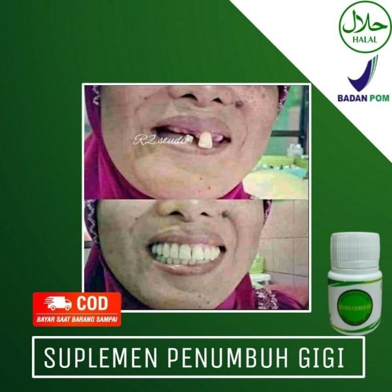 SUPLEMEN PENUMBUH GIGI BOLONG KROPOS DAN OMPONG PERMANEN