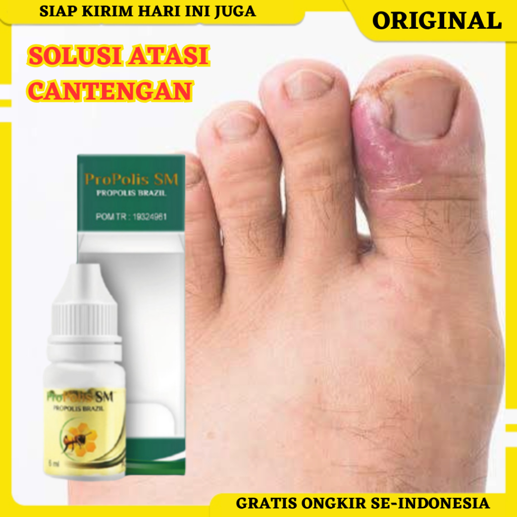 Obat Tetes Cantengan, Obat Cantengan Jempol Kaki, Obat Cantengan Jempol Tangan, Obat Cantengan Berna