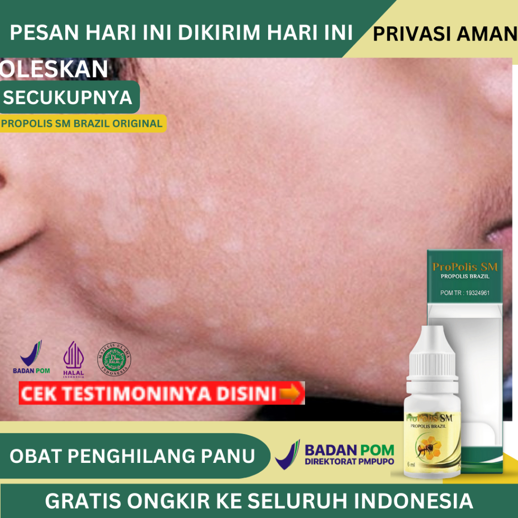 Obat Panu Di Wajah, Obat Hapur Di Wajah, Obat Jamur Kulit di Wajah, Bercak Putih Di Kulit, Balas Bog