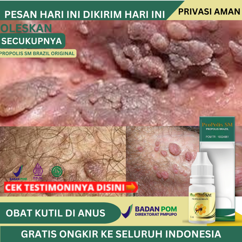 Obat Kutil Kelamin Di Anus, Obat Perontok Kutil di Anus, Obat Kutil di Lubang Anus, Penghancur Kutil