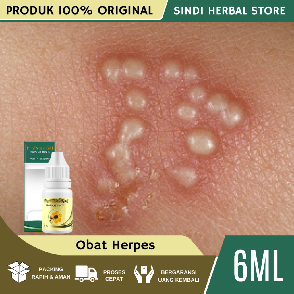 Obat Herpes - Obat Herpes kelamin - Obat Herpes Kulit - Obat Herpes Genital - Obat Herpes Zoster - O