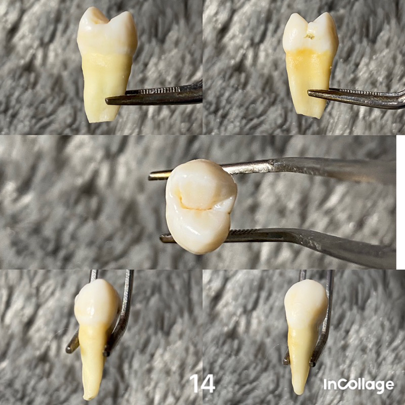 GIGI PREMOLAR RAHANG ATAS