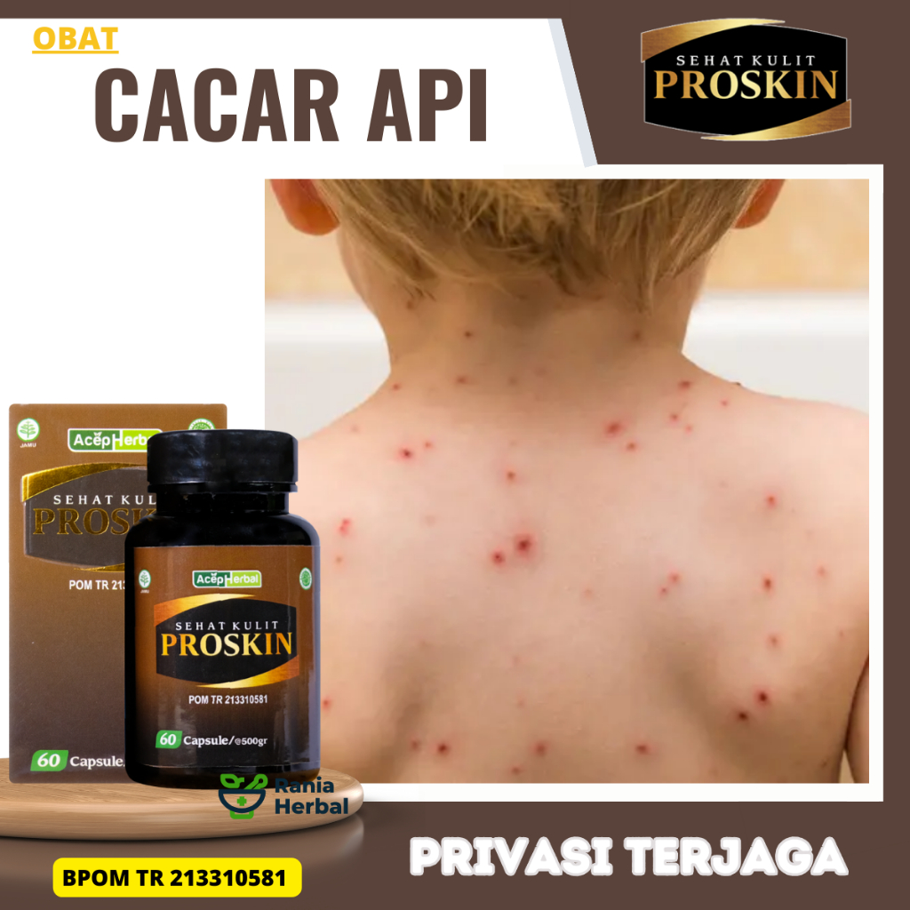 Obat Cacar Api, Menghilangkan Bekas Cacar, Obat Cacar Air, Obat cacar, Obat cacar Anak, Obat Cacar D