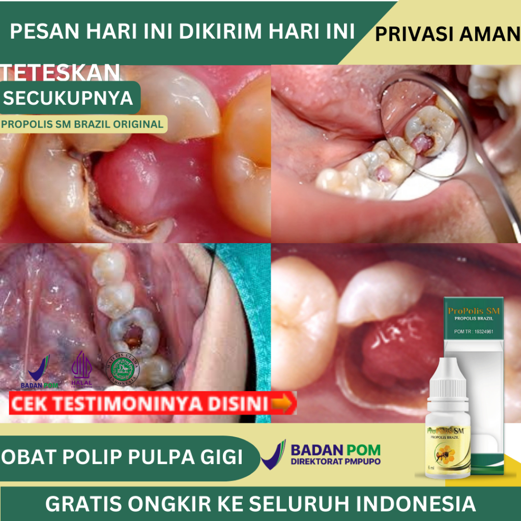 Obat Polip Pulpa Gigi, Obat Penghancur Polip Pulpa, Obat Polip Gigi Berlubang, Obat Penghilang Dagin