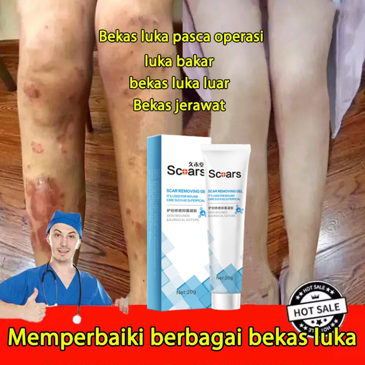 CREAM KRIM PENGHILANG SEGALA JENIS BEKAS LUKA KORENG BUDUKAN KELOID ANAK / DEWASA,MENGHILANGKAN BEKA